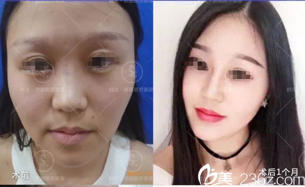 周長兵鼻綜合案例