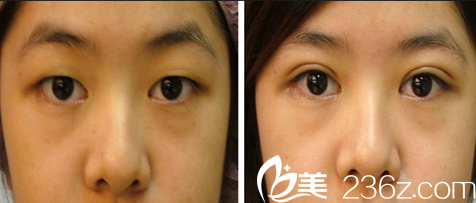 大同美神雙眼皮案例效果圖