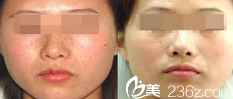 大同美神激光祛斑案例效果圖