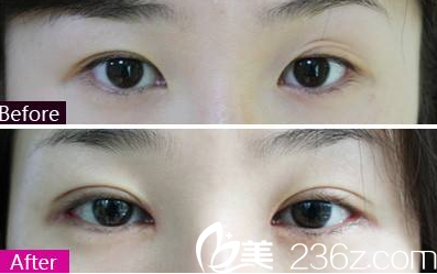 太原歐美蓮白立明雙眼皮失敗修復案例效果對比圖 太原歐美蓮白立明雙眼皮失敗修復案例效果對比圖