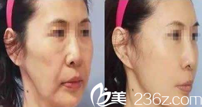 歐美蓮白立明線雕面部提升案例效果圖 歐美蓮白立明線雕面部提升案例效果圖