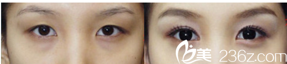 北京上上相醫(yī)療美容醫(yī)院雙眼皮效果 北京上上相醫(yī)療美容醫(yī)院雙眼皮效果