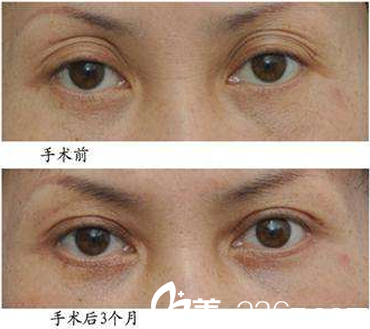 太原歐美蓮白立明雙眼皮失敗修復(fù)效果圖
