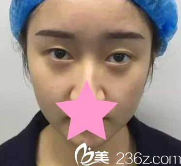 包頭華美整形醫(yī)院割雙眼皮前 包頭華美整形醫(yī)院割雙眼皮前