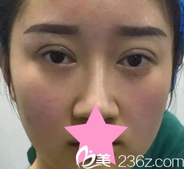 切開(kāi)雙眼皮天效果 切開(kāi)雙眼皮天效果