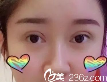 切開(kāi)雙眼皮第十天的效果 切開(kāi)雙眼皮第十天的效果