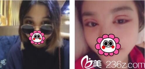 韓國BY整形外科蔡秀旭韓式雙眼皮真人案例術(shù)后第三天