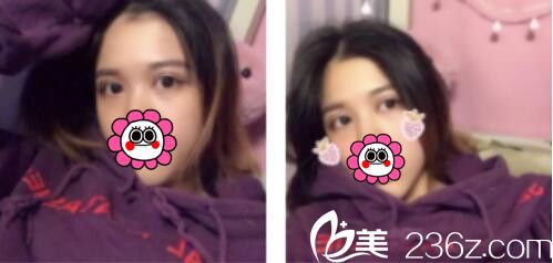 韓國BY整形外科蔡秀旭韓式雙眼皮真人案例術(shù)后第七天