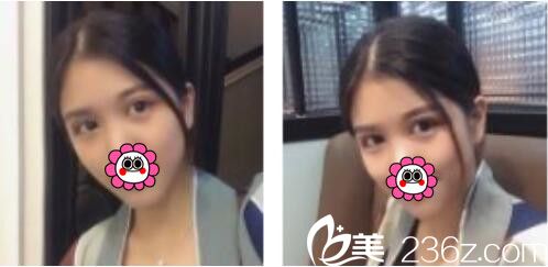 韓國BY整形外科蔡秀旭韓式雙眼皮真人案例術(shù)后一個(gè)月