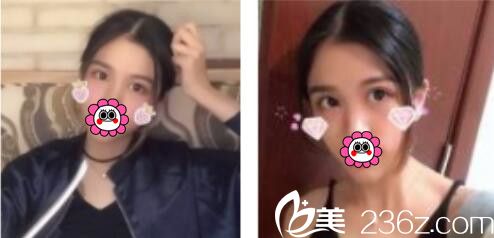 韓國BY整形外科蔡秀旭韓式雙眼皮真人案例術(shù)后兩個(gè)月