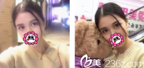 想知道韓式雙眼皮多久能恢復？看韓國BY蔡秀旭為我做的韓式雙眼皮恢復日志