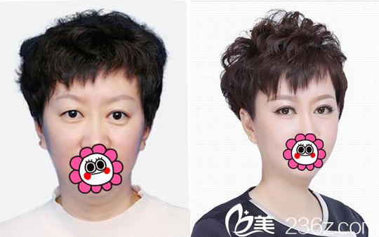 吉林市中妍整形雙眼皮手術(shù)案例 吉林市中妍整形雙眼皮手術(shù)案例