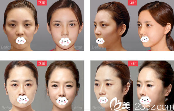 廣元美華整形美容醫(yī)院塑美案例