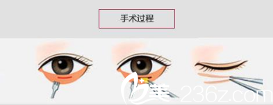 祛眼袋的手術(shù)方法 祛眼袋的手術(shù)方法