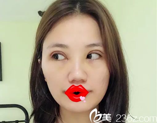 在杭州詮昕做雙眼皮5天<span style=