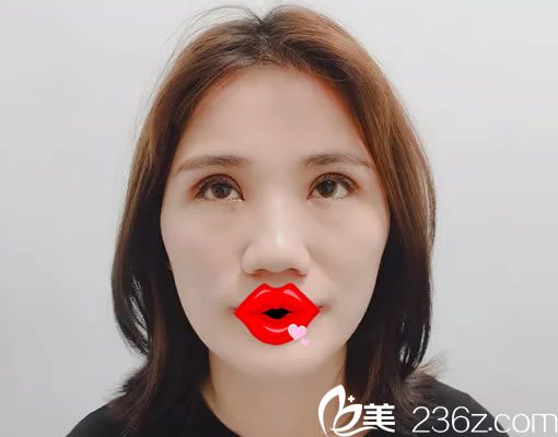 找周做雙眼皮7天恢復(fù)照