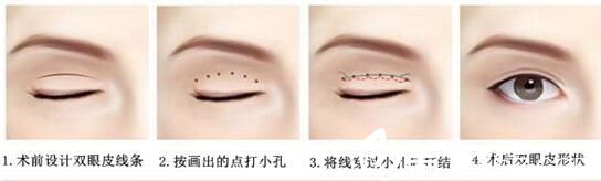 吉林市中妍埋線雙眼皮手術(shù)方法 吉林市中妍埋線雙眼皮手術(shù)方法