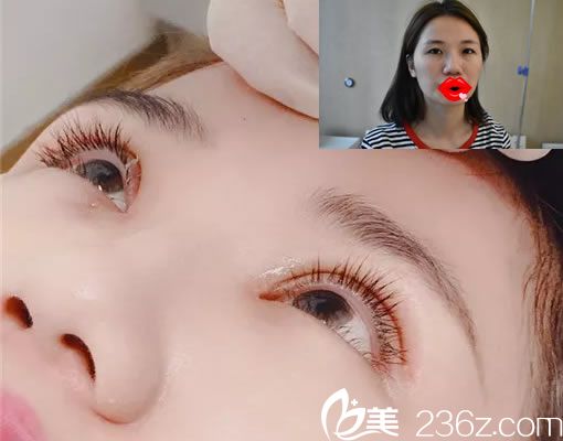 杭州周景和割雙眼皮好嗎？請看杭州詮昕周景和雙眼皮+開眼角真人案例效果