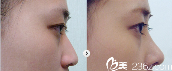 廣元華美楊林隆鼻前后對比 廣元華美楊林隆鼻前后對比