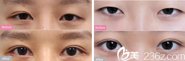 廣元美華整形美容醫(yī)院雙眼皮案例 廣元美華整形美容醫(yī)院雙眼皮案例