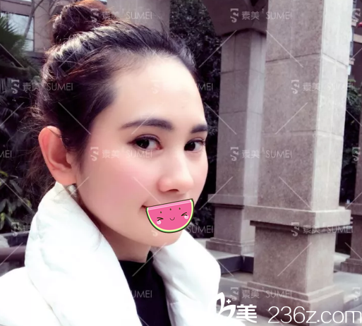 看了不少帕克美眼的案例效果圖 我在找楊迪做了切開雙眼皮