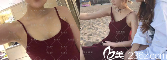 <!--<i data=20240703-sp></i>-->腰腹吸脂+脂肪豐胸術(shù)前照 <!--<i data=20240703-sp></i>-->腰腹吸脂+脂肪豐胸術(shù)前照