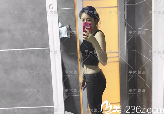 蒲小兵腰腹吸脂術(shù)后5天恢復(fù)效果 蒲小兵腰腹吸脂術(shù)后5天恢復(fù)效果