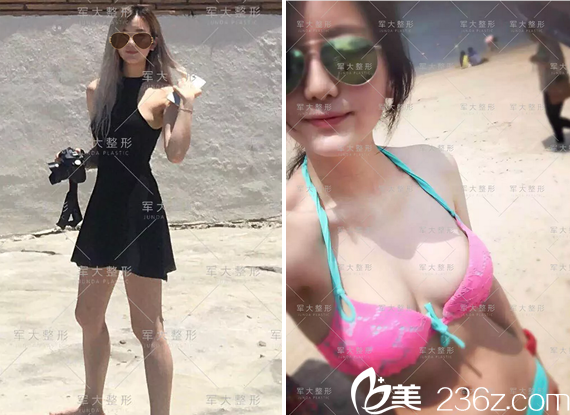 蒲小兵腰腹吸脂+自體脂肪豐胸術(shù)后泳裝照 蒲小兵腰腹吸脂+自體脂肪豐胸術(shù)后泳裝照