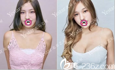 北京藝星<!--<i data=20240703-sp></i>-->假體隆胸<span style= 北京藝星<!--<i data=20240703-sp></i>-->假體隆胸<span style=