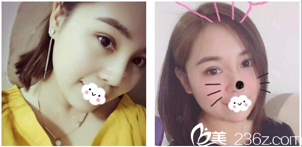 珠海哪里割雙眼皮好？朋友推薦我找珠海九龍整形美容醫(yī)院做的切開雙眼皮