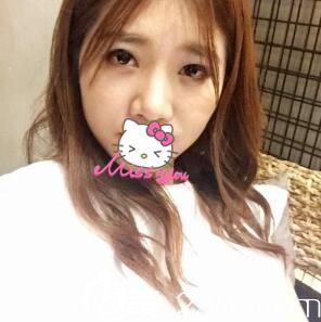 脂肪填充全臉術(shù)前照 脂肪填充全臉術(shù)前照