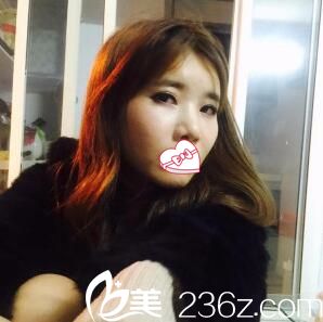 術(shù)后20天效果 術(shù)后20天效果