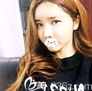 術(shù)后一個(gè)月效果 術(shù)后一個(gè)月效果