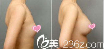 StarM整形外科隆胸案例