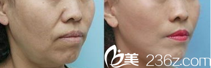 StarM整形外科去法令紋案例