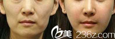 韓國Star M整形外科醫(yī)院自體脂肪填充蘋果肌案例