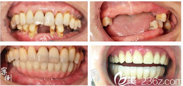 合肥壹加壹牙齒種植案例前后對(duì)比照 合肥壹加壹牙齒種植案例前后對(duì)比照