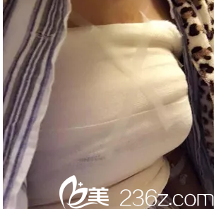 韓國Star M整形外科脂肪豐胸術(shù)后三天效果