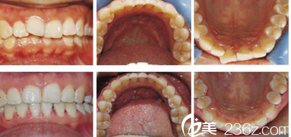 合肥壹加壹牙齒矯正案例恢復(fù)過(guò)程圖 合肥壹加壹牙齒矯正案例恢復(fù)過(guò)程圖