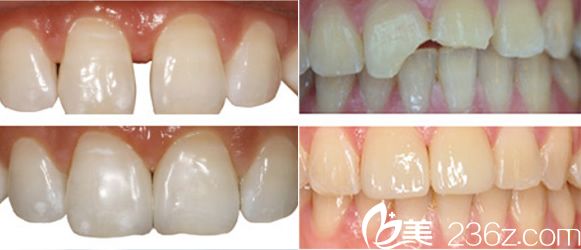 合肥壹加壹牙齒美學(xué)修復(fù)前后對(duì)比圖片 合肥壹加壹牙齒美學(xué)修復(fù)前后對(duì)比圖片