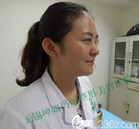 術(shù)前鼻子稍微有些塌陷 術(shù)前鼻子稍微有些塌陷