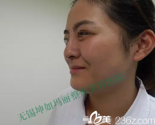 無(wú)錫坤如瑪麗皮膚治療師親自體驗(yàn)注射瑞藍(lán)玻尿酸隆鼻蝶變真人秀 為傘光院長(zhǎng)技術(shù)點(diǎn)贊