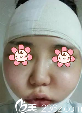 韓國(guó)NEO整形顴骨縮小術(shù)后第2天 韓國(guó)NEO整形顴骨縮小術(shù)后第2天