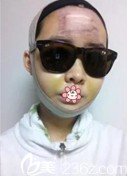 姬廣翰雙鄂+面部輪廓術后10天 姬廣翰雙鄂+面部輪廓術后10天