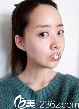 我在重慶美侖美奐做完雙鄂+面部輪廓40天 我在重慶美侖美奐做完雙鄂+面部輪廓40天