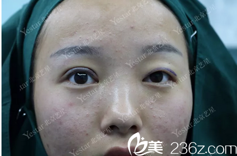 北京藝星慕昕雙眼皮案例術(shù)后照 北京藝星慕昕雙眼皮案例術(shù)后照