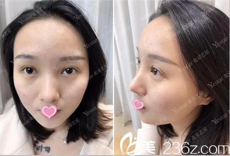 北京藝星整形美容醫(yī)院眼部整形術(shù)后13天效果 北京藝星整形美容醫(yī)院眼部整形術(shù)后13天效果