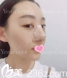 連凱峰鼻綜合術(shù)后13天效果 連凱峰鼻綜合術(shù)后13天效果