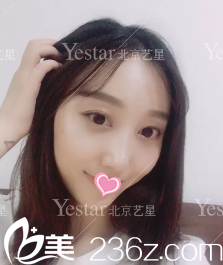 北京藝星連凱峰鼻綜合術(shù)后13天效果 北京藝星連凱峰鼻綜合術(shù)后13天效果