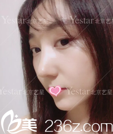 連凱峰鼻綜合術(shù)后28天效果 連凱峰鼻綜合術(shù)后28天效果